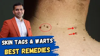 Remove Skin Tags And Warts | Best Home Remedies To Remove Skin Tags And Warts