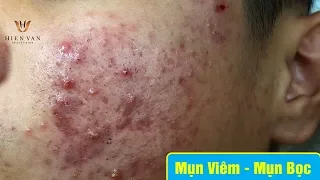 Cách điều trị mụn viêm, mụn bọc hiệu quả | Duy Phương | part 1. Tại Hiền Vân Spa - bài 248