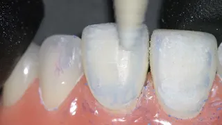 Applying Texture to Composite Resin Veneers