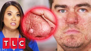 Dr Lee Treats An Autistic Patient With "Wart-Like Bumps" On His Face | Dr. Pimple Popper