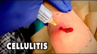 ABSCESS WITH CELLULITIS... (We had to drain it) | Dr. Paul