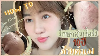 How To การรักษาสิวด้วยตัวเอง ด้วยงบหลักพัน