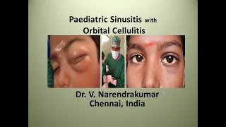 Paediatric Sinusitis with Orbital Cellulitis - Dr. V. Narendrakumar