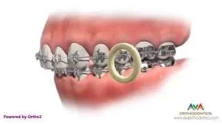 Orthodontic Rubber Bands - If Not Worn As Instructed
