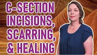 How to Care for Cesarean Section Scars and Incisions | C- Section Scar Healing, Recovery & Treatment
