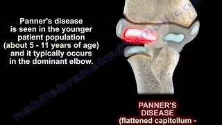 Panner's Disease - Everything You Need To Know - Dr. Nabil Ebraheim