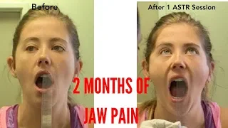 Unbearable Chronic * TMJ/Jaw Pain * RELIEVED In No Time (THIS WORKS!!!)