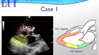 UltrasoundPodcast.com - Wall Motion Ultrasound