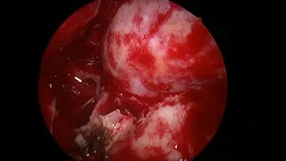 Orbit 2  Thyroid orbitopathy