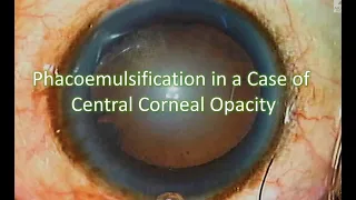 CCS: PHACOEMULSIFICATION IN A CASE OF CENTRAL CORNEAL OPACITY