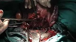 Caesarean Section: Closing the uterine incision