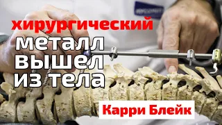 Хирургический металл вышел из тела | Карри Блейк