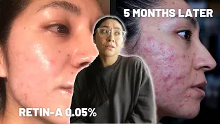 5 months on Retin-A: Still purging???