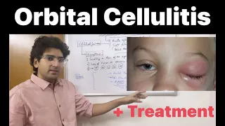 Orbital Cellulitis (Pathology, Clinical features and Treatment)