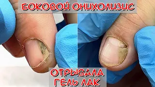 Онихолизис ногтей на руках / Боковой онихолизис