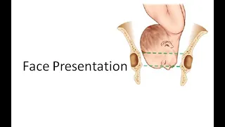 Obstetrics 471 Face Presentation ROP LMA MentoAnterior MentoPosterior Flanks not full No Moulding