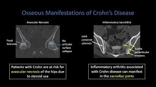 Crohn Disease Part 3   Extraintestinal Findings