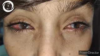 Severe Limbal VKC Challenging case 127