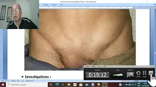 Hernia in Arabic 4 ( External Abdominal Hernia , part 3 ) , by  Dr.Wahdan