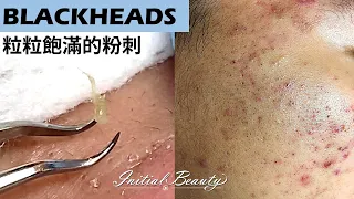 粒粒飽滿的粉刺( blackheads ) - Taiwan Tainan台南清粉刺最乾淨