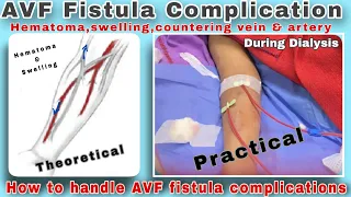 AV fistula Needling complication during Hemodialysis