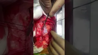 Total Arterial Revascularization