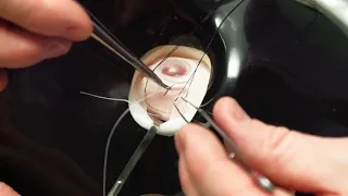 Simulated Surgery: Retinal Buckling: Placing the Sutures for a Scleral Buckle