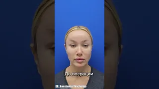 Первое впечатление после вторичной ринопластики😯