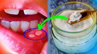 Афтозный Cтоматит (язвочки во рту). Домашнее Лечение