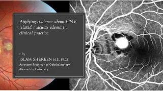 Applying evidence about CNV related macular edema in clinical practice