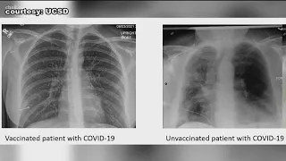 Here's how lung X-rays look between vaccinated and unvaccinated patients