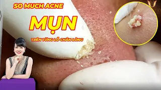 Điều trị mụn ẩn, mụn đầu đen hiệu quả tại TPHCM | Hiền Vân spa | Hidden Acne Treatment | 647