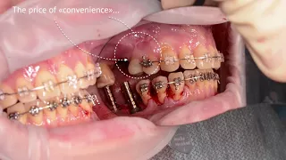 GBR Dentium Implants