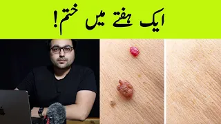 Dr. Zee:How to Rid Skin Tags and Warts | Quick fix | त्वचा के तिल