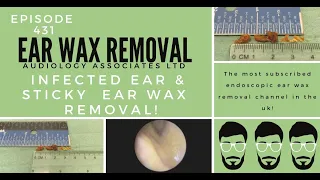 INFECTED EAR & STICKY EAR WAX REMOVAL - EP431
