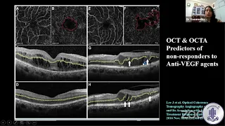 Walk in Retina Patient in your OPD: Diabetic Macular Edema by Dr Vasumathy Veedantham