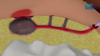 cisti sacrococcigea o pilonidale tecnica SiLaC Sinus Laser Closure video animazione SiLaC animation