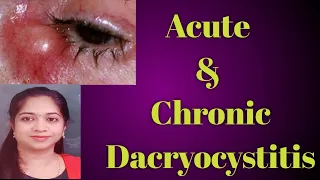 Dacryocystitis || Acute dacryocystitis|| Chronic Dacryocystitis|| Stages of Dcryocystitis|| Mucocele