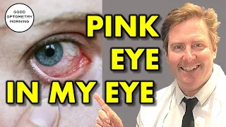 WHAT IS PINK EYE: conjunctivitis, red eye infections, types & treatment from your youtube eye doctor