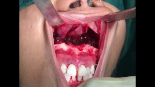 Orthognathic Surgery - Intra Operative View after downfracture