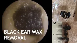BLACK EAR WAX REMOVAL - #437