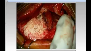 Supratentorial Arteriovenous Fistulas: Nuances of Technique for Microsurgical Ligation (Preview)