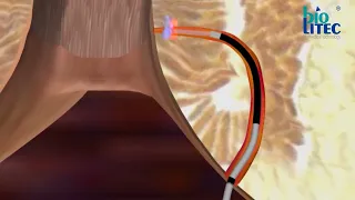 Fistola Anale tecnica FiLaC - Fistula Laser Closure video Animazione FiLaC Animation