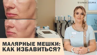 МАЛЯРНЫЕ МЕШКИ ❌ СУФЫ ПОД ГЛАЗМИ😱👉🏻 Как избавиться⁉️