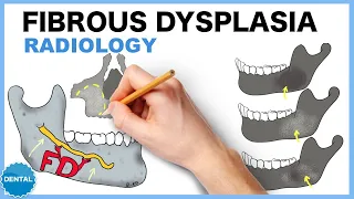 Fibrous dysplasia: Radiology