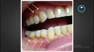 Desgaste en el cuello de los dientes