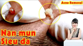 Điều trị mụn hiệu quả TPHCM | Hiền Vân spa | Acne removal | Mụn bọc, mụn viêm | Đỗ Thu Hiền | 620