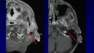 Salivary3