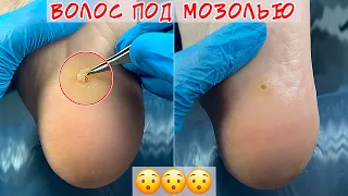 Стержневая мозоль удаление / Заноза из волоса😮