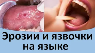 Эрозии и язвочки на языке